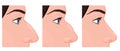 Face side view_Rhinoplasty