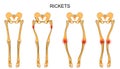 The skeleton of the lower limbs in rickets Royalty Free Stock Photo