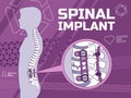 Vector illustration of the spinal implant medical Royalty Free Stock Photo