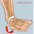 Vector illustration of a Sprained ankle Royalty Free Stock Photo