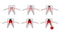 Vector illustration of the stages of caries on the teeth. Dental chart