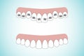 Vector illustration of the stages of orthodontic treatment braces on teeth . Teeth before and after braces on . Background in flat