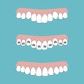 Vector illustration of the stages of orthodontic treatment braces on teeth . Teeth before and after braces on . Background in flat