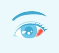 Vector illustration of subconjunctival hemorrhage Royalty Free Stock Photo