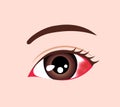 Vector illustration of subconjunctival hemorrhage Royalty Free Stock Photo