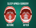 Vector illustration of surgery for obstructive sleep apnea.