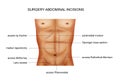 Surgical incisions of the abdominal cavity Royalty Free Stock Photo