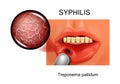 Syphilis. chancre. Treponema pallidum Royalty Free Stock Photo