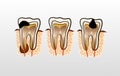 Vector illustration of tooth Decay Caries