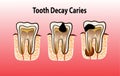 Vector illustration of tooth Decay Caries