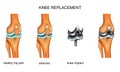Knee joint endoprosthesis