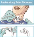 vector illustration of a tracheostomy tube placement