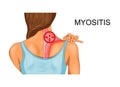 Trapezius muscle. the incidence of myositis