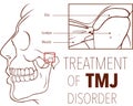 Vector illustration of treatment of tmj disorder Royalty Free Stock Photo