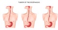 Tumor of the esophagus