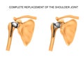 The types of prosthesis of shoulder Royalty Free Stock Photo