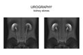 Urography. kidney stones