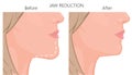 Face side view_Chin Reduction close up Royalty Free Stock Photo