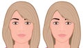 Face front_Jaw reduction surgery Face Royalty Free Stock Photo