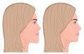 Face side view_Chin Reduction Royalty Free Stock Photo