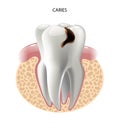 Vector image tooth caries disease Royalty Free Stock Photo