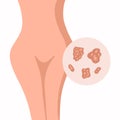 Vector isolated illustration of genital herpes in women.