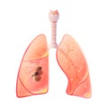 Vector illustration of lung cancer Royalty Free Stock Photo