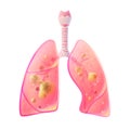 Vector illustration of lung cancer