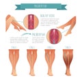 Vector Phlebology infographic. Stage of vein diseases