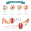Vector Phlebology infographic, treating varicose veins. Female legs. Medical compression hosiery
