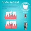 Vector realistic, 3D set of dental implants with installation in the gum. Structural elements of dental implant isolated Royalty Free Stock Photo