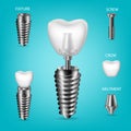 Vector realistic, 3D set of dental implants. Structural elements of a dental implant, isolated. Royalty Free Stock Photo