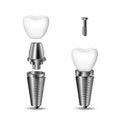 Vector realistic, 3D set of dental implants. Structural elements of a dental implant. Isolated on white background. Royalty Free Stock Photo