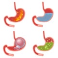 Vector Realistic Stomach medical vector illustration set. Pyrosis fire disorder, gastric acid reflux, Abdominal bloated