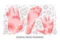 Vector set. Eczema, illness symptom, bacteria. Skin rashes on arm, hand. Art illustration