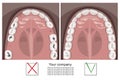 A teeth on the jaw looking over before and after the dentist or orthodontist with place for text, a flat vector stock illustration