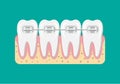 Vector teeth braces flat illustration