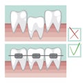 Vector teeth with braces on a healthy gum, a healthy bite concept with molars for orthodontist