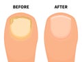 Vector toe nail before and after fungal disease