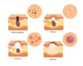 Vector types of acne