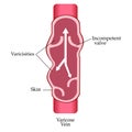 Vector varicose vein. Varicose vein.