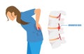 Vector of a woman with a low back pain and sciatica from a herniated disc Royalty Free Stock Photo