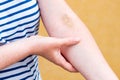 Vein hematoma on female hand after phlebotomy Royalty Free Stock Photo