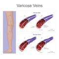 Vein pressure have become enlarged and twisted on the leg, result from damaged blood pressure valves. Illustration.