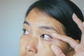 Veins on red eye asian woman,Eyelid layer,Causes the use of eyes and not enough rest Royalty Free Stock Photo