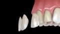 Veneer installation procedure over central incisor and lateral incisor