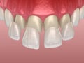 Veneer installation procedure over central incisor and lateral incisor. Medically accurate tooth illustration Royalty Free Stock Photo