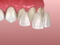 Veneer installation procedure over central incisor and lateral incisor. Medically accurate tooth illustration Royalty Free Stock Photo