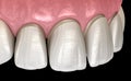 Veneer installation procedure over central incisor and lateral incisor. Medically accurate tooth illustration