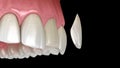 Veneer installation procedure over central incisor. Medically accurate tooth 3D illustration